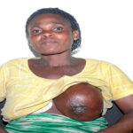 Breast Cancer in Nigeria