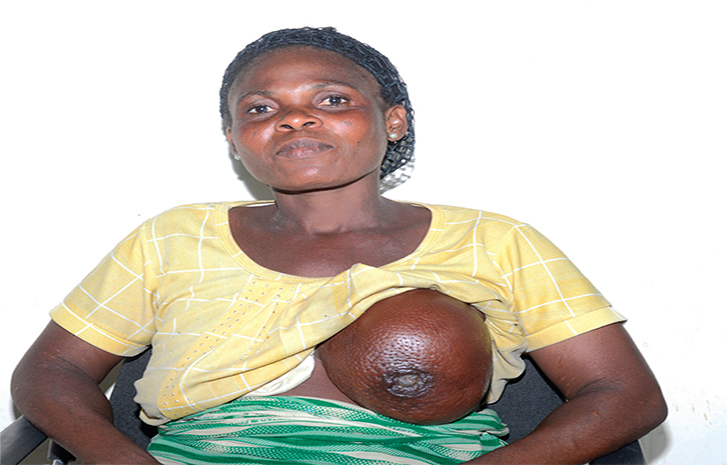 Breast Cancer in Nigeria