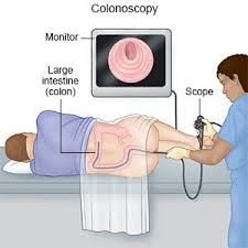 Colonoscopy