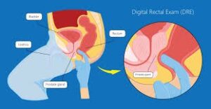 Digital Rectal Exam (DRE)