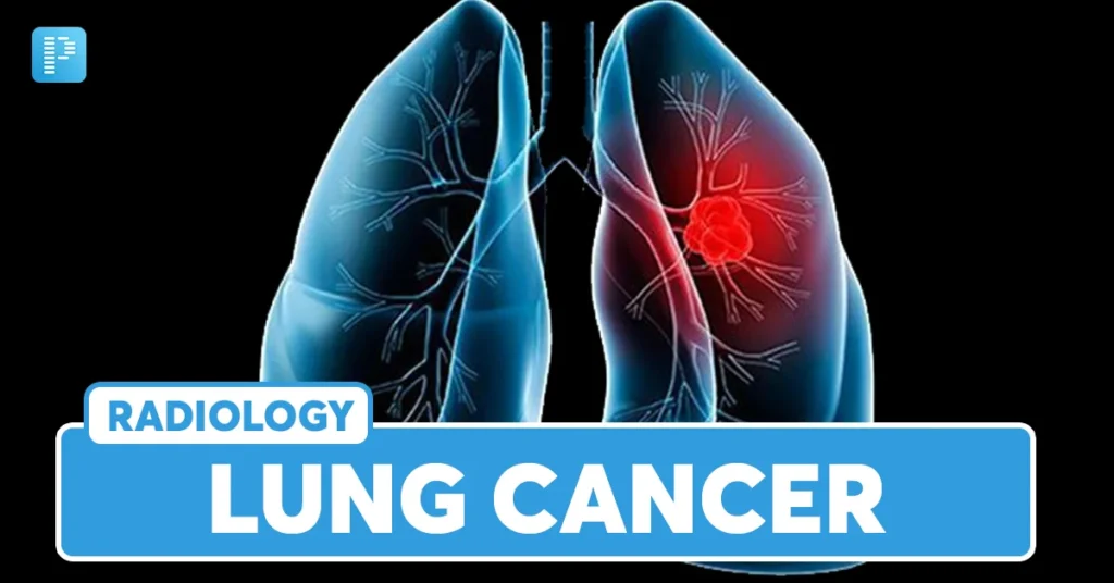 Diagnosis of lung cancer