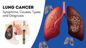 TYPES OF LUNG CANCER