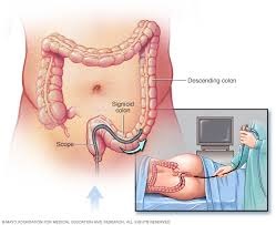 Sigmoidoscopy