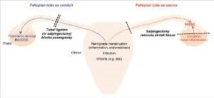 TUBAL LIGATION AS A RISK REDUCTION STRATEGY OF OVARIAN CANCER