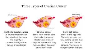 TYPES OF OVARIAN CANCER