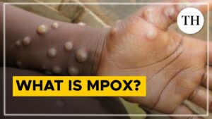 What is mpox