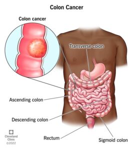  What is colon cancer