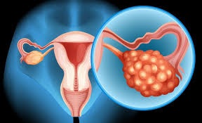 OVARIAN CANCER