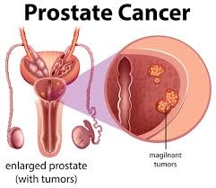 WHAT IS PROSTATE CANCER?