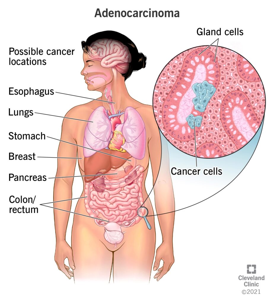 Carcinoma