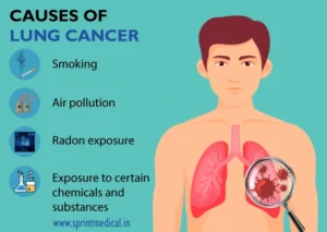 CAUSES OF LUNG CANCER