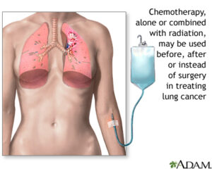 Chemotherapy lung cancer treatment