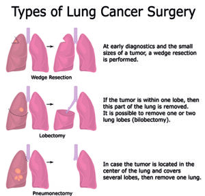 types of lung cancer