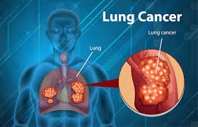 understanding lung cancer