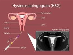 Hysterosalpingography