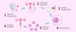 In Vitro Fertilization (IVF)