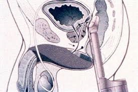 Obstructions in the Reproductive Tract