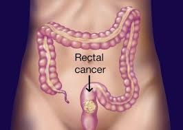 RECTUM CANCER