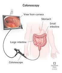 Screening Methods for Rectal Cancer