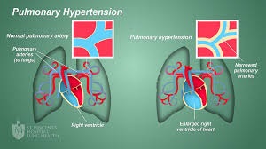 What is Pulmonary Hypertension?