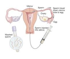 intrauterine Insemination